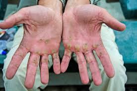 Blisters on hands from rowing without gloves